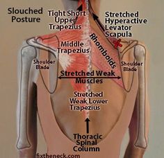 Overcoming Chronic Neck Pain: Postural Causes and A Unique Exercise Fix Shoulder Blade Stretch, Muscle Stretches, Middle Back Pain, Spinal Column, Cervical Spine, Upper Back Pain, Hip Flexor, Shoulder Pain