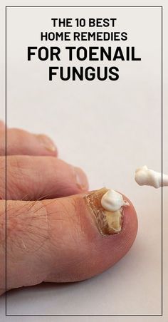 Toenail Fungal Infection, Toenail Fungus Remedies, Nail Fungus Remedy, Nail Infection, Fungal Nail, Ingrown Toe Nail, Toenail Fungus, Nail Fungus