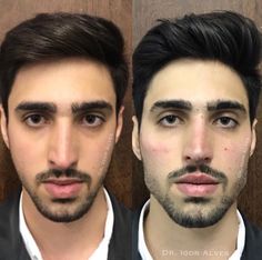 #plasticsurgery #plasticsurgerygonewrong #beforeafter #celebritiesbeforeafter #hollywoodstars #bignosesurgery #surgery #facesurgery #vlinesurgery #koreanplasticsurgery #kpopplasticsurgery #nosejob #jawreductionsurgery #eyesurgery #cheekfillers #rhinoplasty #facelift #plasticsurgeryfails #expensiveplasticsurgery Male Nose Job, Lip Surgery, Guys Grooming, Men Skin Care Routine