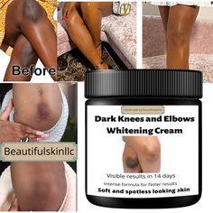 This Moisturisers item by Beautifulskinllc has 209 favorites from Etsy shoppers. Ships from United States. Listed on 05 May, 2023 Dark Knees And Elbows, Healthy Sauce, Dark Spots On Legs, Dark Knees, Dark Neck, John Currin, Dark Elbows, Cream For Dark Spots, Remove Unwanted Hair