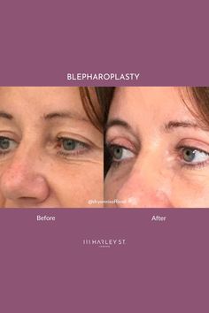 A Blepharoplasty is a procedure that can improve the appearance of the lower and upper eyelids, for a brighter-eyed appearance. Is Blepharoplasty right for you? Visit our website to book your consultation with our expert practitioners today. 📱 DM for enquiries⁠ 💻 www.111HarleyStreet.com⁠ ☎️ +44 344 692 1111⁠ 📍 111 Harley Street, Marylebone, London, W1G 6AW⁠ Marylebone London, Upper Eyelid