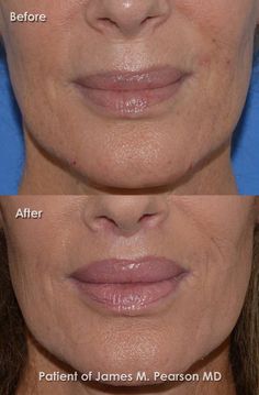 Lip Implants, Ethnic Rhinoplasty, Restylane Lyft, Cheek Lift, Chin Augmentation, Nose Reshaping, Laser Resurfacing