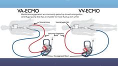 Extracorporeal Membrane Oxygenation (ECMO) Nursing Terminology, Cath Lab Nursing, Cardiac Anatomy, Respiratory Failure, Cardiac Sonography, Cvicu Nursing, Cardiogenic Shock, Vascular Ultrasound