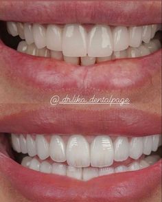 Pretty Teeth Smile, Whiten Teeth Fast, I Healed, Tooth Decay Remedies, Natural Face Care