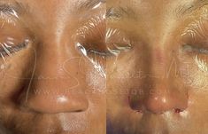 Black Women Nose Job, Nose Jobs Black Women, African American Rhinoplasty, Small Nose Tip, Nose Manifestation