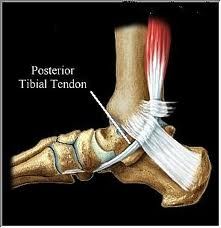 Posterior Tibial Tendon Dysfunction, Posterior Tibial Tendon, Psoas Release, Ankle Pain, Psoas Muscle, Hip Flexor