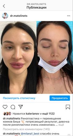 Nose Rhinoplasty Before After, Nose Job Before And After Bulbous, Rhinoplasty Front View, Rhinoplasty Before After, Wide Nose Rhinoplasty, Nose Job Before And After, Ethnic Nose Job, Natural Nose Job