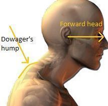 Follow these simple exercises to fix your Dowager's hump right now. Get rid of the bump at the base of your neck once and for all. Simple Exercises, The Bump, Back Exercises, Health Exercise, Neck Pain, Head And Neck