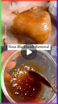 Baking Soda And Apple Cider Vinegar Face Mask, Best Mask For Blackheads, Diy Facemask Skincare Blackheads, Face Mask That Pulls Out Blackheads, How To Make Face Mask For Blackheads, Blackheads Mask Diy, Face Pack For Blackheads, What Helps Get Rid Of Blackheads, How To Make Skin Poreless