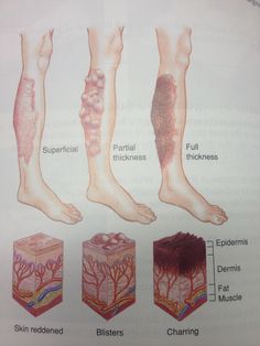 the diagram shows different types of foot pain