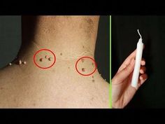 HOW TO REMOVE SKIN TAGS OVERNIGHT & NATURALLY | Skin Tag Removal | Skin Tags Home Remedy (Fast)🔸Keywords:skin tags, skin tags, skin tags on neck. how to rem... Remove Skin Tags, Tag Remover, Lifting Facial, Single Candle, Skin Care Remedies