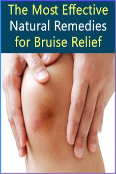 Bruises, or contusions, occur when small blood vessels near the skin's surface break and leak blood into the surrounding tissue, resulting in discoloration and tenderness. While bruises typically heal on their own over time, there are several natural remedies that can help speed up the healing process and alleviate discomfort. Here are some of the most effective natural methods for relieving bruises:\nThe Most Effective Natural Remedies for Bruise Relief How To Get Rid Of Bruising Fast, Medical Words, Preventative Health, Alternative Treatments, Homeopathic Remedies, Clean Living, Summer Inspo, Alternative Health