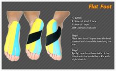 I only use the arch piece of this, and it really helps. The pieces across the bottom of the foot just felt wasteful. Flat Feet Exercises, Foot Exercises, Flat Foot, Sports Therapy