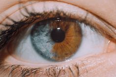 3 types of heterochromia: complete, central and sectoral – Rh Negative Blood and People Cat Eye Syndrome, Sectoral Heterochromia, Bowie Eyes, Hair Whorl, Different Colored Eyes, Eye Photography