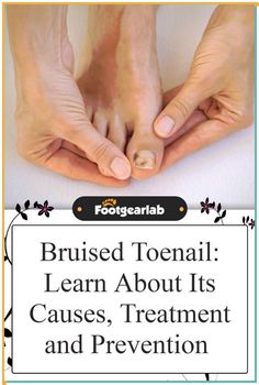 Bruised Toenail: Find out more about bruised toenails, starting with its primary causes. Afterward, learn various preventive measures and treatment options for the ailment. #BruisedToenail #ToenailPain Toenail Pain, Workout Chart, Toning Workouts, Foot Health, Brain Health, Blood Vessels, Skin Care Acne, Physical Fitness