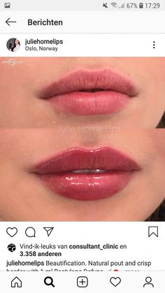 Pillow Lips Injections, Julie Horne Lip Filler, Heart Shaped Lip Filler, Natural Lip Fillers 1ml, Russian Lips Filler Before And After, Russian Lips Filler, 0.5 Ml Lip Filler Before And After, Lip Filler Shape Ideas