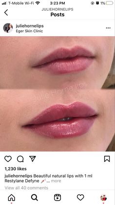 Dermal Fillers Lips, Juvederm Lips, Lip Permanent Makeup, Permanente Make-up, Botox Lips, Facial Fillers, Lip Augmentation, Facial Aesthetics