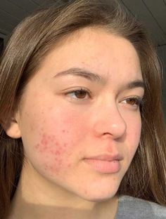 Girls With Acne, Post Acne Marks, Acne Skincare, Acne Treatments, Combo Skin