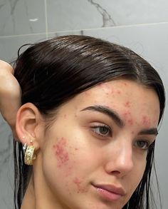 Girl With Acne, Best Dark Spot Corrector, Dark Spot Corrector, Bare Beauty, Facial Skin Care Routine, Love Your Skin, Pretty Skin, My Beauty, Acne Skin