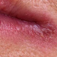 Skin Conditions on and Around Your Mouth Chapped Skin Around Mouth, Severe Chapped Lips, Skin Issues On Face, Mouth Blister Remedy, Dry Skin Around Mouth, Rash Around Mouth, Mouth Blisters, Blister On Lip, Swollen Lips