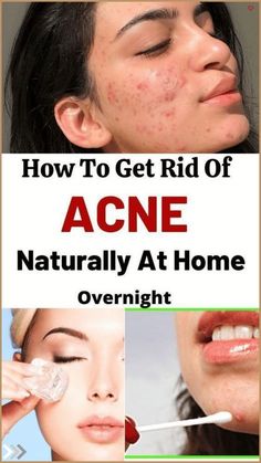 Goodbye Acne: Unleash Clear Skin with These Unexpected Natural Remedies Best Way To Get Rid Of Acne, How To Clear Acne Scarring, Bad Acne, Get Rid Of Acne, Overnight Beauty, Rid Of Acne, Brown Spots Removal, Natural Acne