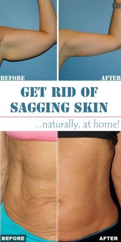 6 Wonderful Home Remedies for Sagging Skin One of the worst things about crepey skin is that it sags. Learn the secrets to improve your skin.