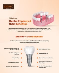 Dental implants are considered as one of the most beneficial restorative treatments. In the dental implant procedure, an artificial tooth root is inserted into the gums. The implantation is done if people have one or more real missing teeth. Dentistry Quotes, Clove Dental, Missing Tooth, Diy Tie Dye Shirts, Teeth Implants, Diy Tie