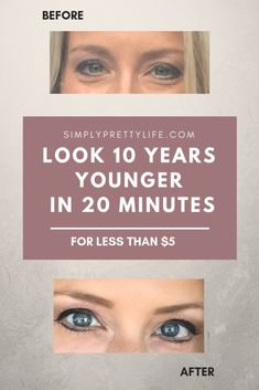 Pretty Life, Under Eyes, Eyes Problems, Under Eye Bags, Natural Beauty Tips, Years Younger, Eye Bags, Look Younger, Beauty Treatments