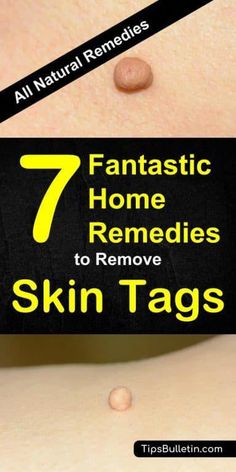 Skin tags are mainly just annoying but can be unsightly, too. Learn how to remove skin tags the easy way with our home remedies. Skin Tags On Face, Skin Natural Remedies, Natural Health Care