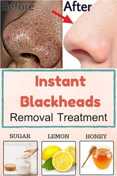 Skin Beauty Hacks for all Obličejové Masky, Blackheads On Nose, Lemon Honey, Blackhead Removal, Get Rid Of Blackheads, Natural Cough Remedies, روتين العناية بالبشرة, Skincare Video