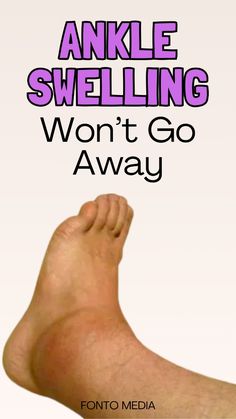 Your ankle is swollen (with or without pain) after an impact a fall, surgery, or for no apparent reason? My best tips for your recovery! Swollen Ankles Remedies, Ankle Swelling Remedies, Swollen Ankle Remedies, Swelling In Feet And Ankles Remedies, Swelling Feet Remedies, Reduce Ankle Swelling, Ankle Surgery Recovery, Ankle Swelling