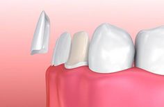 Alpha Dental Care provides porcelain veneers installation services for the residents of Milton and surrounding areas. Dental Cover, Composite Veneers, Veneers Teeth, Dentist Visit, Tooth Enamel, Dental Crowns