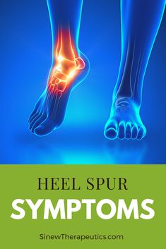 Bone Spur On Back Of Heel, Bone Spur Heel, Heal Pain Relief, Heel Spur Relief Remedies, Heal Spur Remedies, Heal Spurs, Heel Spur Relief, Sore Heels, Plantar Fascitis