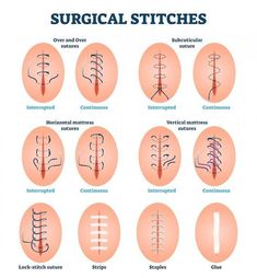 an image of surgical stitches chart