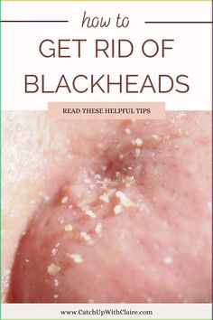 Blackheads are a common skin concerns and this is everything you need to know to get rid of them and prevent them from returning #spot #blackheads #blackheadspopping #blackheadsremover #blackheadremoval #blackheadremedy #blackheadremovalremedies #removeblackheads #skin #skincare #beautyblog #catchupwithclaire What Causes Pimples, Pimples On Scalp, Tea Tree Face Wash, How To Remove Blackheads, Clear Skin Routine, Blackhead Remedies, To Remove Blackheads, Rid Of Blackheads, Blackhead Mask