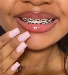 Black braces Braces Black Bands, Maroon Braces Teeth, Black Braces Color, Braces For Black Women, Braces Aesthetic Girl Black, Pink And Black Braces, Black Braces Power Chain, Smiley Piercing With Braces