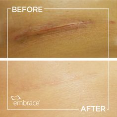 Laser Scar Removal, Scar Revision, Scar Repair, Hypertrophic Scars, Scar Reduction, How To Fade, Scar Cream, Arm Lift, Normal Body