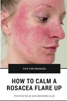 How to calm a rosacea flare up: tips and tricks you can do at home. Skincare for sensitive skin. #talontedlex #rosacea At Home Skincare, Skincare For Sensitive Skin, Coffee Facial, Glowing Radiant Skin, Home Remedies For Hair, Sensitive Skin Care, Skin Complexion, Combination Skin, Skin Conditions