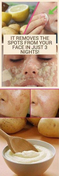 Sun Spots On Skin, Black Spots On Face, Brown Age Spots, Brown Spots On Skin, Spots On Legs, Dark Spots On Face, Brown Spots Removal, Brown Spots On Face, Skin Spots