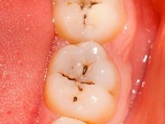 How to Reverse Cavities Naturally and Heal Tooth Decay.  This article also has a recipe for mineralizing toothpaste and explains oil pulling. Reverse Cavities Naturally, Reverse Cavities, Teeth Health, Oil Pulling, Diy Health, White Teeth, Tooth Decay, Back To Nature, Healthy Teeth