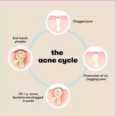 -Understanding acne cycles and treating each type effectively-♻️✅.                                                               Credits: @proactiv @thecleanskincarequiz Acne Chart, Different Types Of Acne, Skin Care Pictures, Skin Facts, Ad Ideas, Types Of Acne, Cystic Acne, Acne Remedies