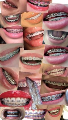 aparat na zeby Perfect Teeth Braces, Dental Braces Colors, Braces Rubber Bands, Cute Braces Colors, ليلو وستيتش, Braces Tips, Grillz Teeth, Getting Braces, Cute Braces