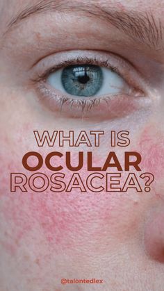 What is ocular rosacea? How do you treat ocular rosacea? Is ocular rosacea serious? Questions about rosacea type 4? I'm here to help! Skincare For Rocesea, Skin Care 30s Women, 30s Women, Serious Questions, Saving Face, Get Clear Skin, Eye Problems, Pimples On Face, Moisturizer For Sensitive Skin