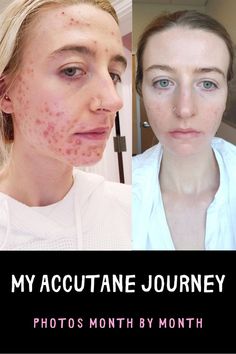 Accutane Survival Products, Doxycycline For Acne Before And After, Acutane Before After, Accutane Month By Month, Acne Pit Scars, Accutane Survival, Accutane Before And After, Improve Vision, Teenage Acne