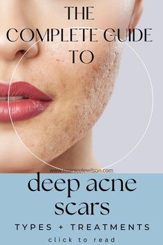 guide to get rid of deep acne scars Scar Removal, How To Get Rid Of Acne