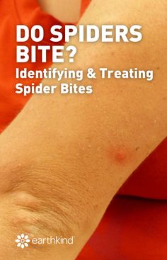 a person with spider bites on their arm and the text do spiders bite? identifying & treating spider bites