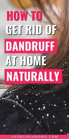 How To Get Rid Of Dandruff Overnight, Get Rid Of Dandruff Permanently, Natural Remedies For Dandruff, Get Rid Of Dandruff Fast, How To Remove Dandruff, Natural Dandruff Remedy, Hair Mask For Dandruff, Clear Scalp, Home Remedies For Dandruff