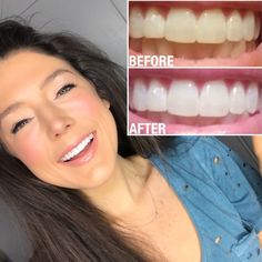 a woman smiling and showing her teeth before and after whitening with dental floss