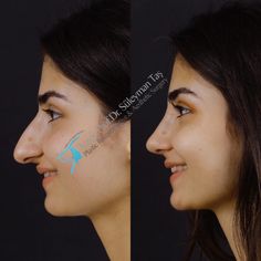 Long Nose Rhinoplasty, Natural Rhinoplasty Nose Jobs, Long Nose, Models With Big Noses, Rhinoplasty Side Profile, Rhinoplasty Bulbous Nose, Refined Tip Rhinoplasty