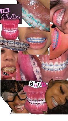 Light Blue Braces, Dental Braces Colors, Pink Braces, Braces And Glasses, Cute Braces Colors, Pretty Teeth, Braces Tips, Getting Braces, Cute Braces